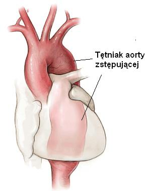 tętniak aorty zstepującej